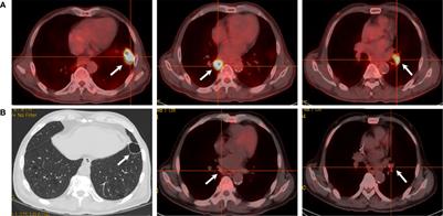 Case Report: Hepatic Sarcoid-Like Reaction Associated With Checkpoint Inhibition in a NSCLC Patient and a Literature Review